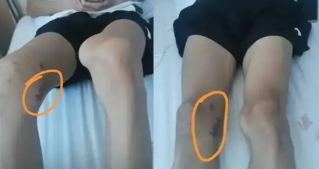 醫院回應醫生錯切體育生膝蓋